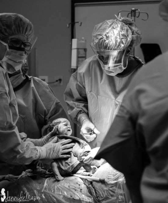 A császármetszés is lehet gyönyörű szülésélmény - megható fotók A császármetszés is lehet gyönyörű szülésélmény - megható fotók