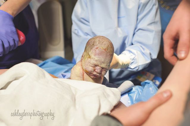 A császármetszés is lehet gyönyörű szülésélmény - megható fotók A császármetszés is lehet gyönyörű szülésélmény - megható fotók