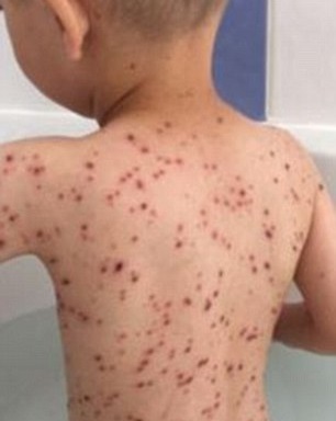 Kis híján belehalt a bárányhimlőbe a kisfiú, mert rossz gyógyszert írtak fel neki