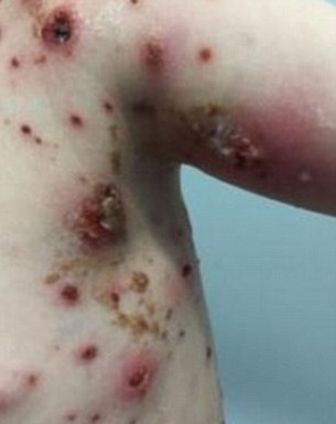 Kis híján belehalt a bárányhimlőbe a kisfiú, mert rossz gyógyszert írtak fel neki