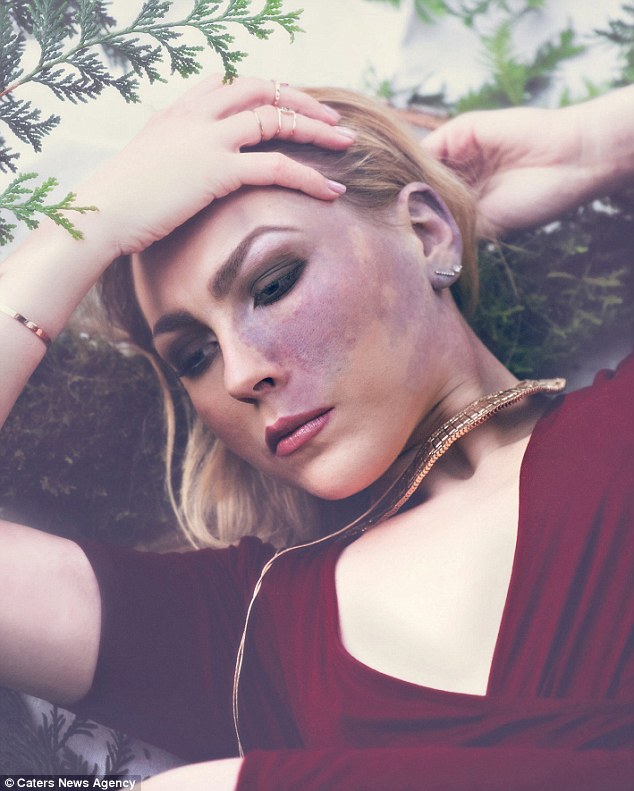 Egész életében bántották bőrhibája miatt a lányt - most arra tanít, hogyan fogadjuk el magunkat