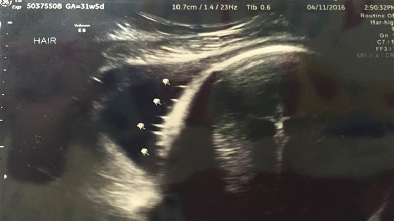 Döbbenetes dolgot látott az ultrahang képén a kismama