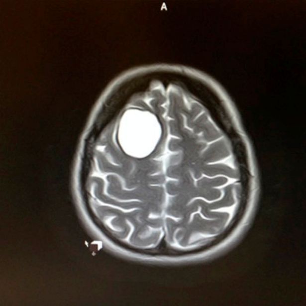 Még születése előtt megmentette anyja életét a kisbaba