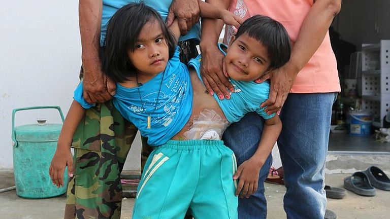 A sziámi ikrek nem akarják, hogy szétválasszák őket A sziámi ikrek nem akarják, hogy szétválasszák őket