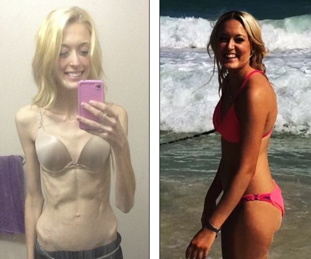 Kilenc hónap alatt 20 kilót fogyott – kis híján meghalt 