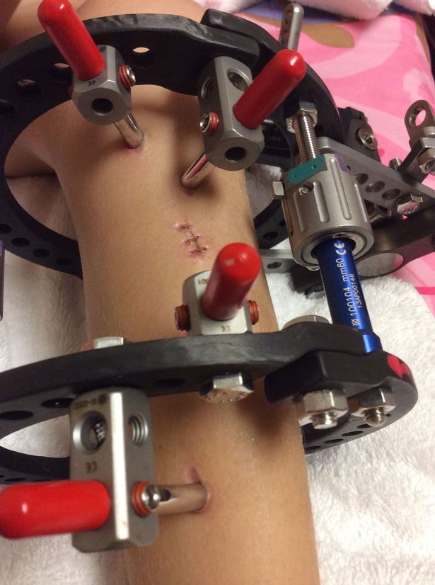 Több, mint 300 alkalommal törte el lánya lábát, hogy megmentse az amputációtól