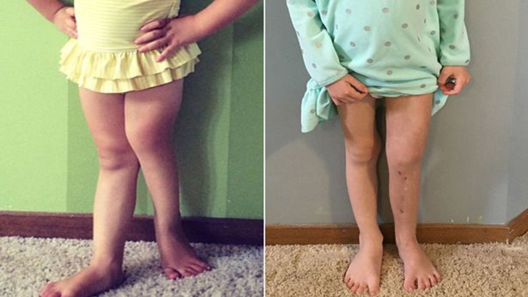 Több, mint 300 alkalommal törte el lánya lábát, hogy megmentse az amputációtól