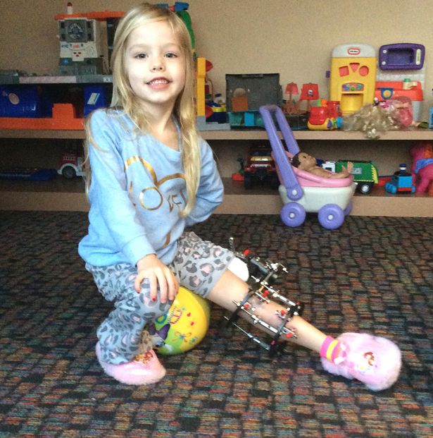 Több, mint 300 alkalommal törte el lánya lábát, hogy megmentse az amputációtól