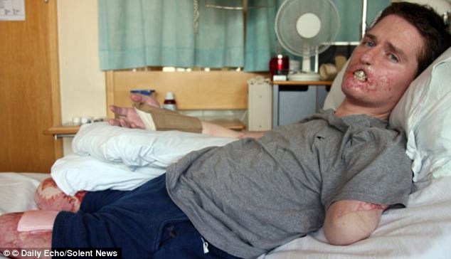 Azt hitte, náthás - végül mind a négy végtagját és az arcát is elveszítette a fiatal apuka