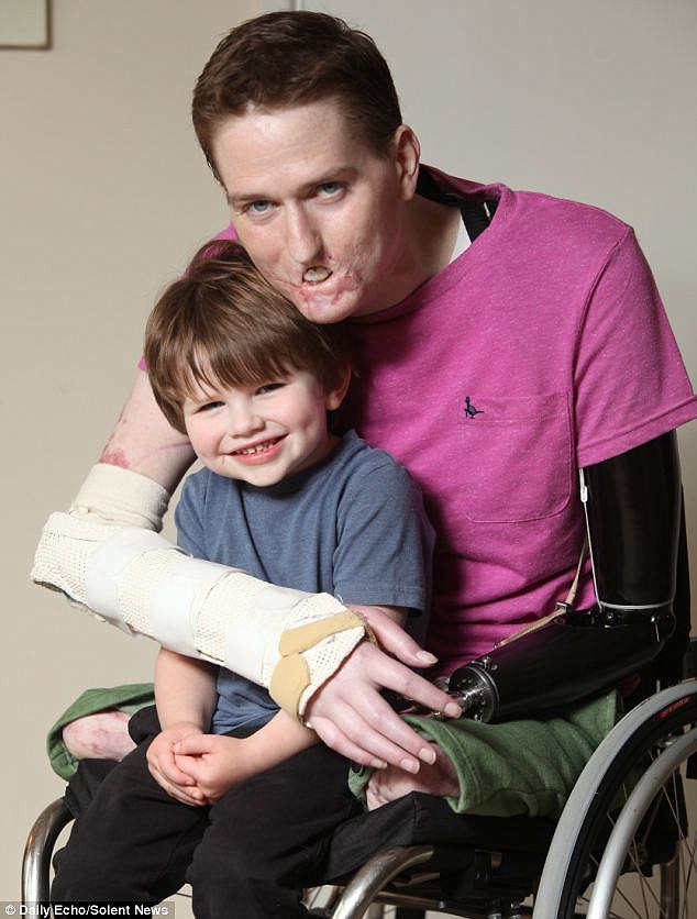 Azt hitte, náthás - végül mind a négy végtagját és az arcát is elveszítette a fiatal apuka