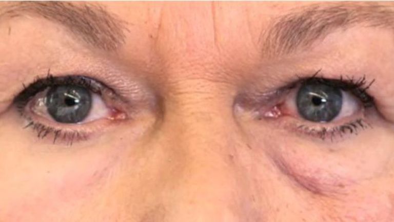 Jól látszik, hogy a jobb szem alatt sokkal kevésbé táskás és ráncos a bőr