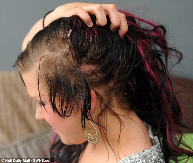 Foltokban megkopaszodott a hajragasztótól egy nő