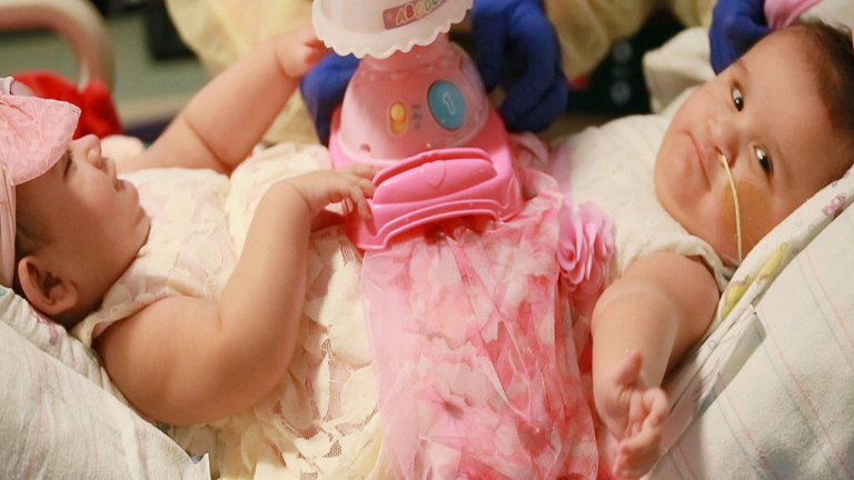 Első szülinapjukra elhagyhatták a kórházat a szétválasztott sziámi ikrek