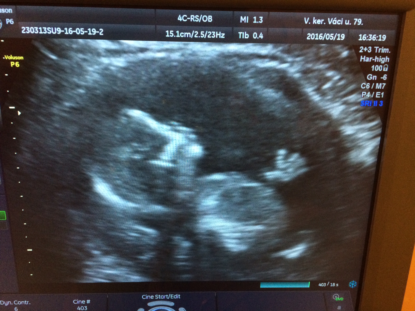  Legyőzte a rákot és a meddőséget, most boldog kismama Viktória