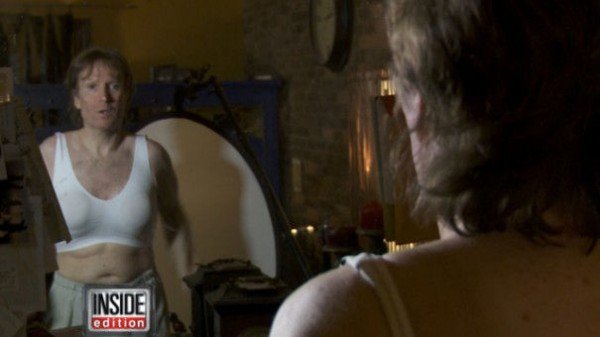 Fogadásból rakatott be magának mellimplantátumokat egy férfi - 20 év után most megvált tőlük Fogadásból rakatott be magának mellimplantátumokat egy férfi - 20 év után most megvált tőlük