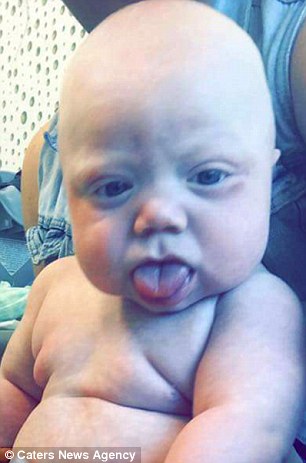 Újra mosolyoghat a rendellenes nyelvvel született baba