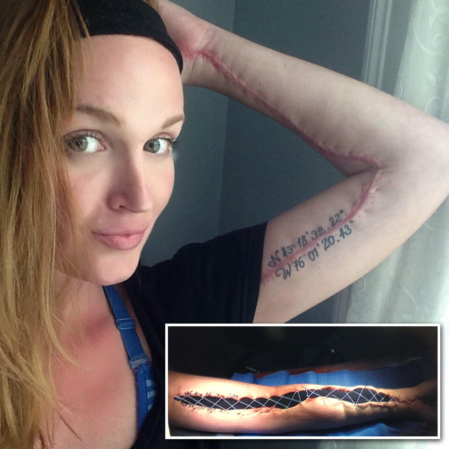 Horror: egyszerű horzsolásnak tűnt a nő sérülése - kiderült, hogy húsevő baktérium támadta meg