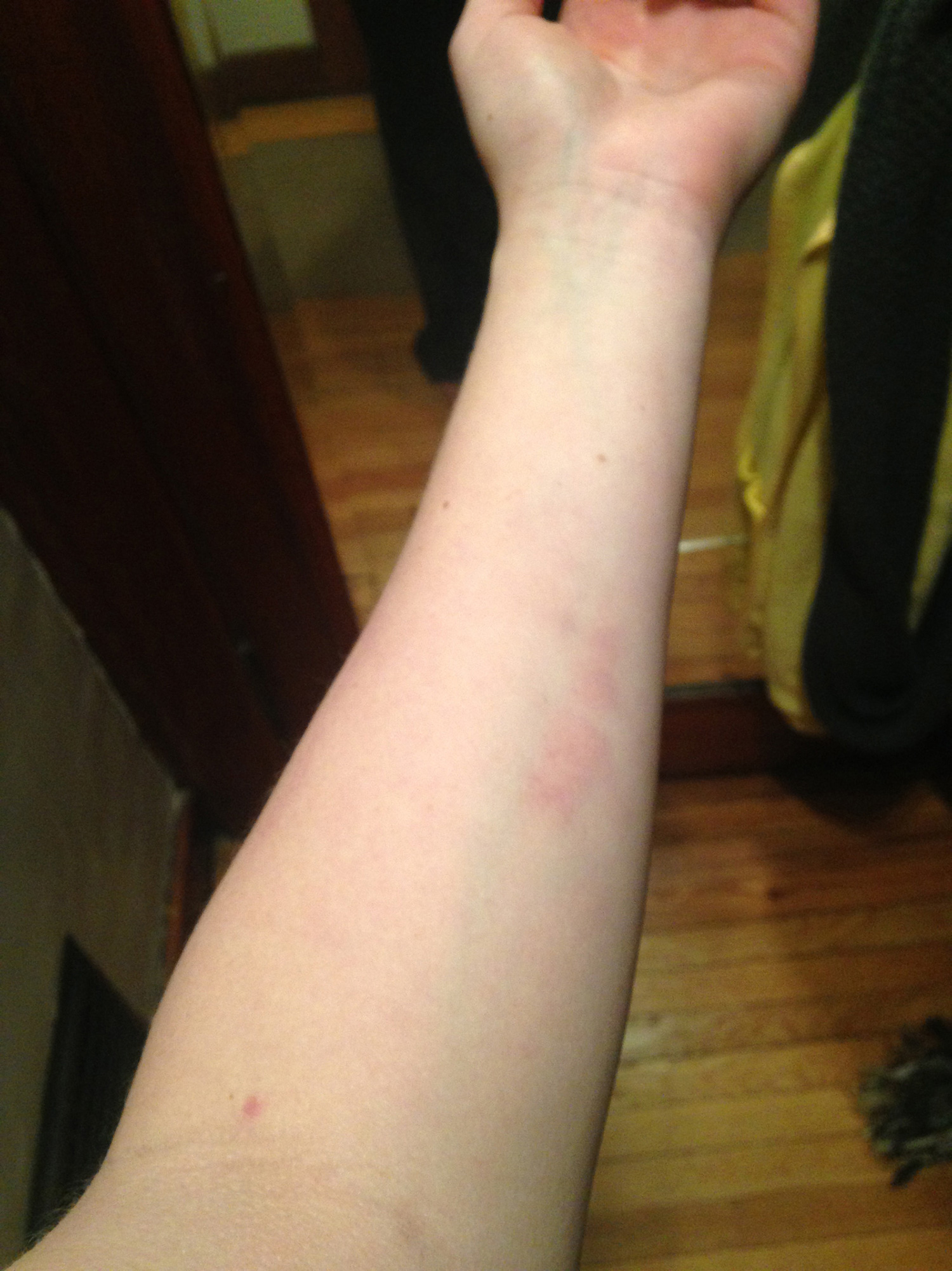 Horror: egyszerű horzsolásnak tűnt a nő sérülése - kiderült, hogy húsevő baktérium támadta meg