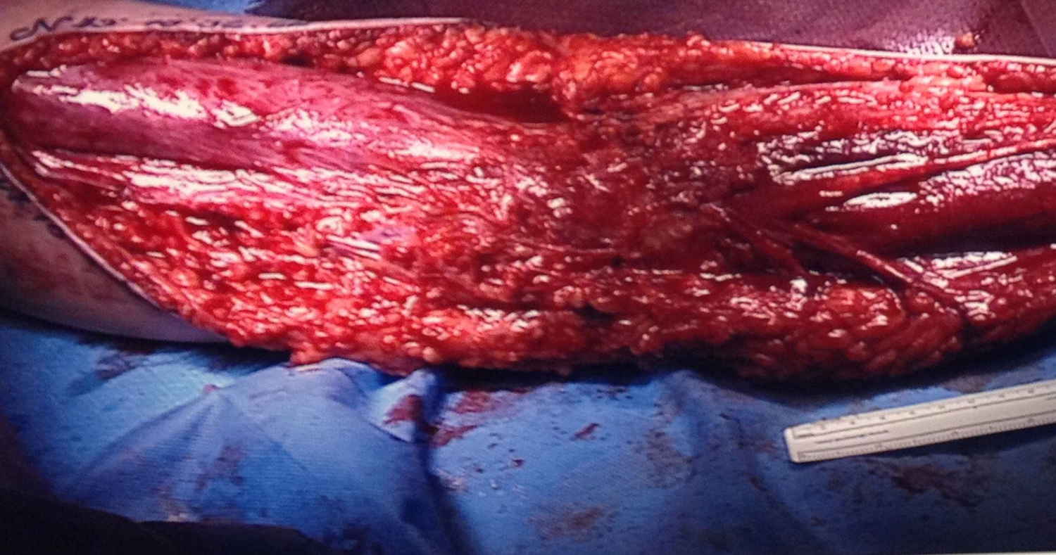 Horror: egyszerű horzsolásnak tűnt a nő sérülése - kiderült, hogy húsevő baktérium támadta meg