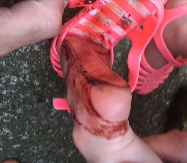 Elképesztő dolgot művelt a kétéves kislány lábával a szandál