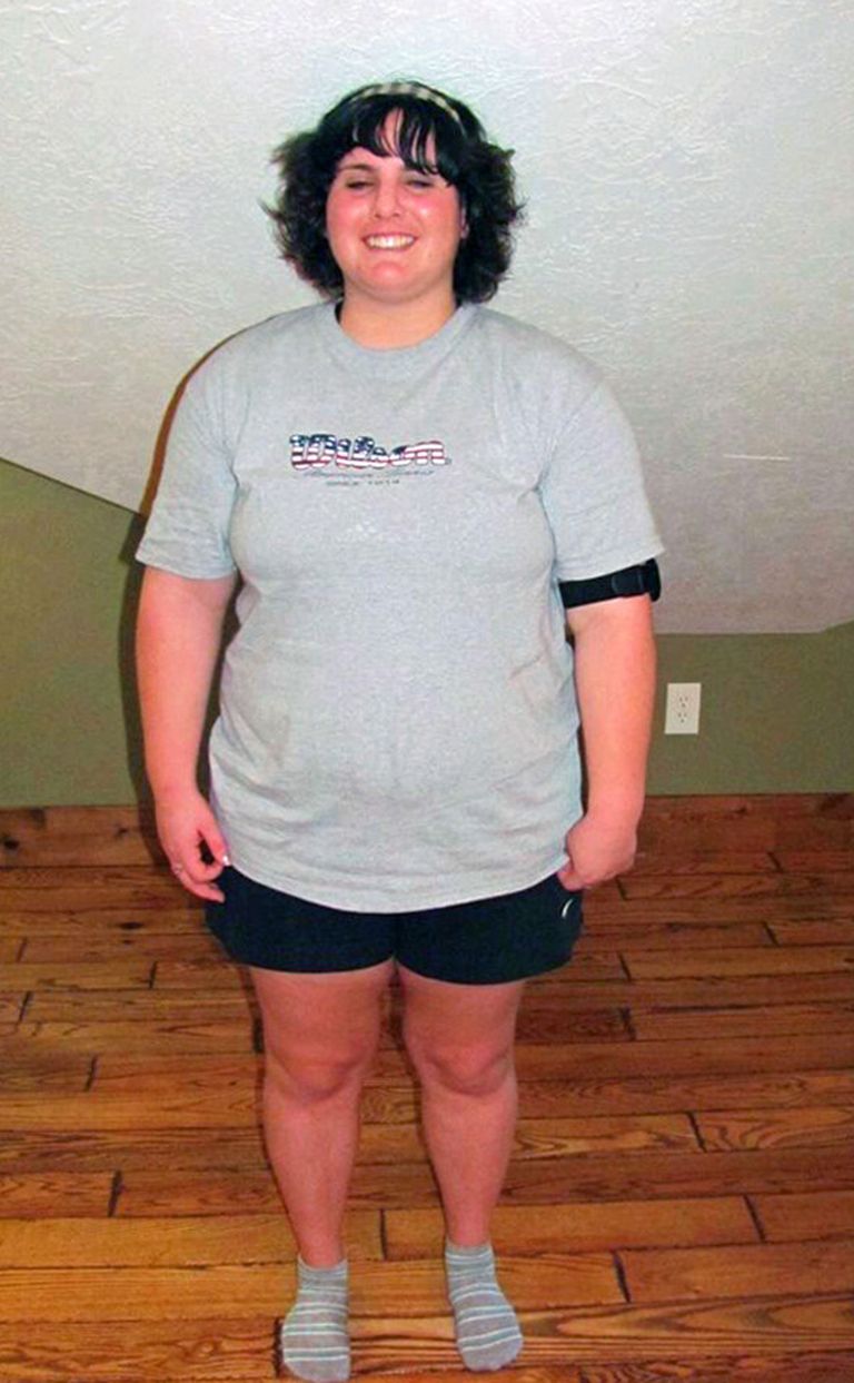 Előbb anorexiás lett, azután elhízott Előbb anorexiás lett, azután elhízott