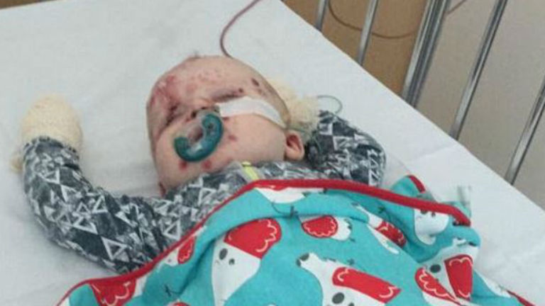 Bárányhimlős lett 11 hónapos kisfia – ijesztő képet tett róla közzé 