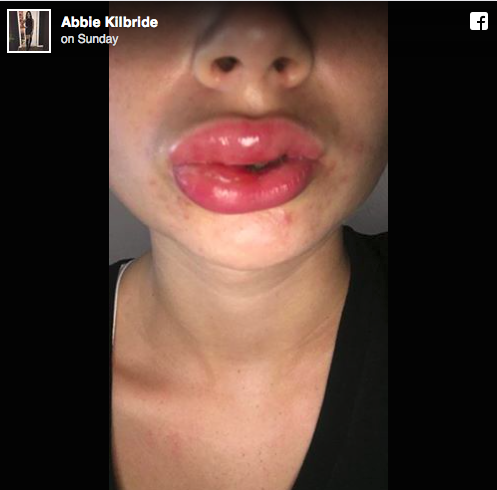 Mindenkit figyelmeztet a lány, akinek csúnyán eltorzult arca a fogfehérítéstől