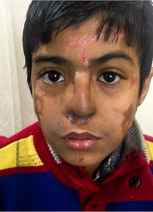 A homlokára növesztettek orrot