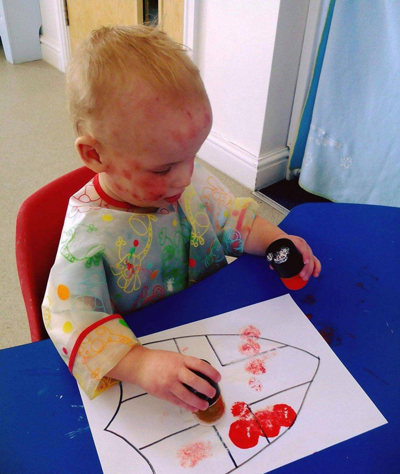 Súlyos bőrbetegsége miatt úgy néz ki a kisbaba, mintha állandóan vernék Súlyos bőrbetegsége miatt úgy néz ki a kisbaba, mintha állandóan vernék