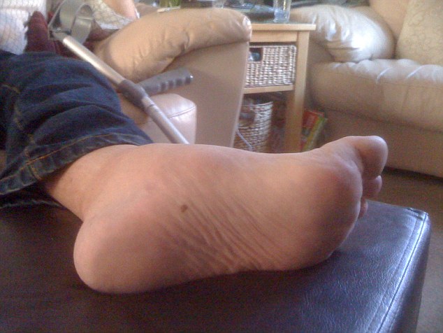 Fiainak köszönheti a cukorbeteg férfi, hogy nem veszítette el a lábát