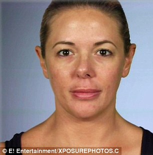 21 évig szenvedett az elrontott orrplasztikája miatt