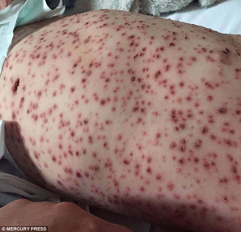 Az orvosok sem láttak még ilyen súlyos bárányhimlőt