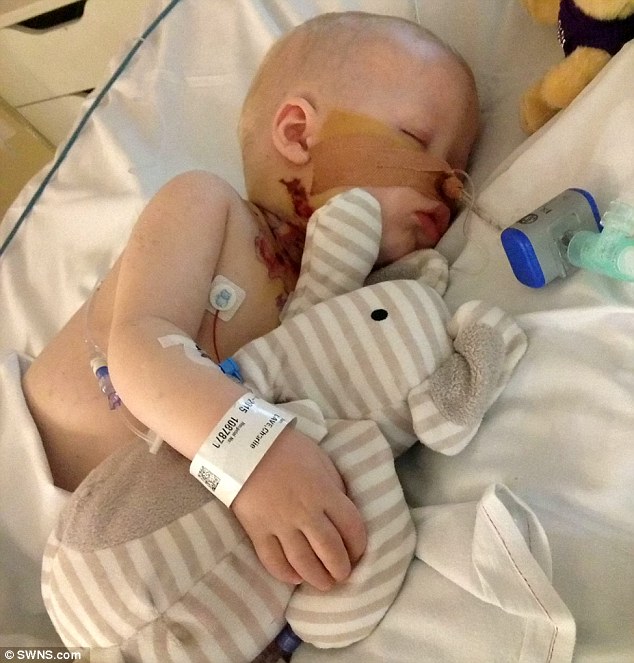 Majdnem meghalt a kisfiú, akinek bárányhimlőjéről kiderült, hogy húsevő baktérium