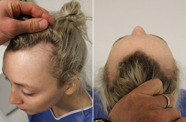 Kontyban hordta a haját, csúnya következménye lett - fotók