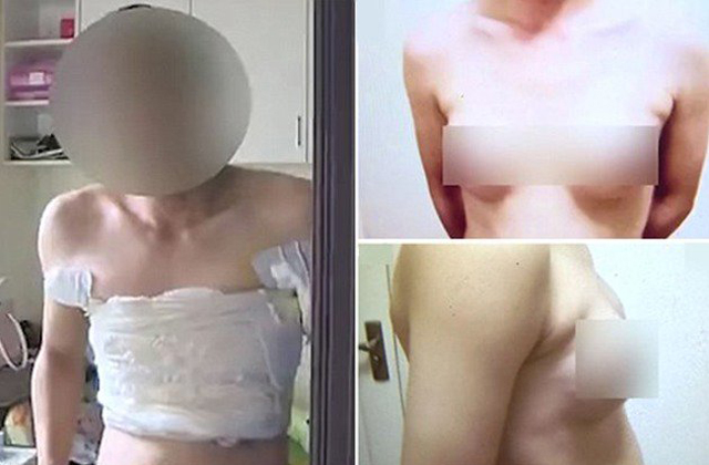 Műmelleket csináltatott a férfi, hogy állást kapjon