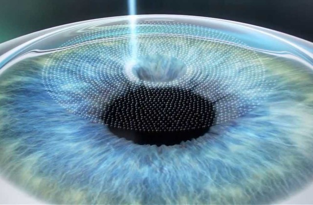 Műttetnéd a szemed? - ezek a legmodernebb látáskorrekciós műtétek