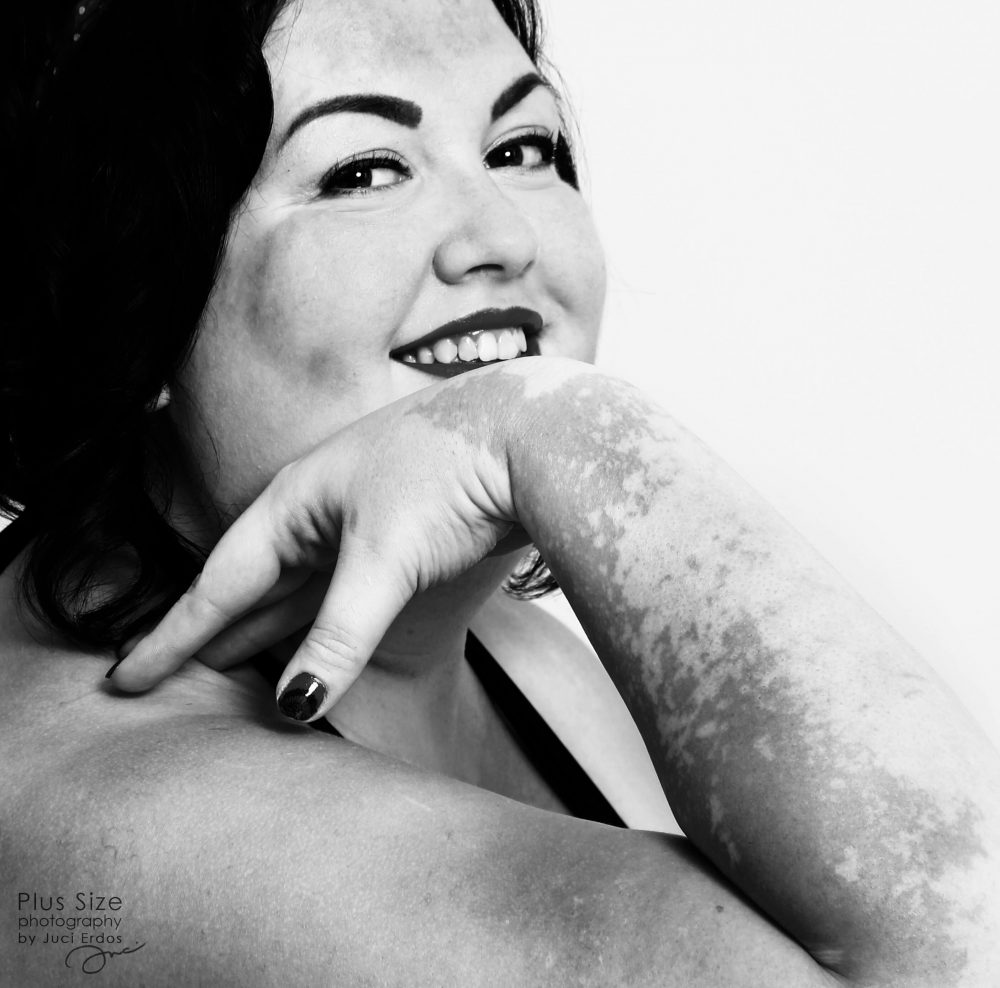 Gyönyörű fotók egy magyar vitiligós plus size nőről, akire öröm ránézni