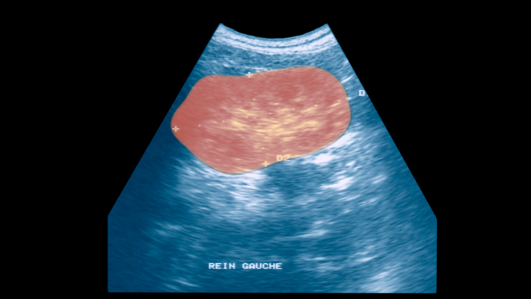 A vese ultrahangos vizsgálata
