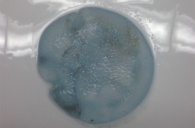 Mellimplantátumnak nézte a döglött medúzát