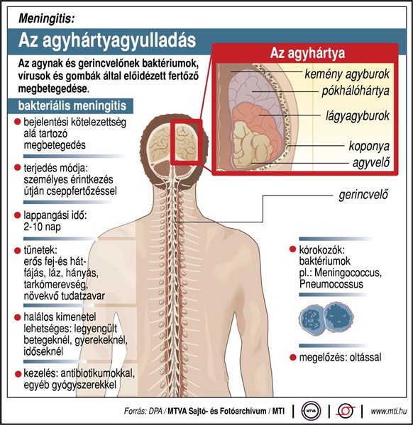 Agyhártyagyulladás: 