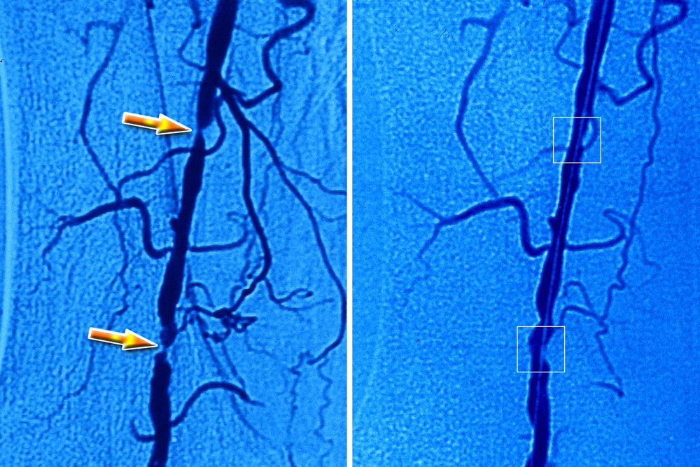Nem fáj, de életet menthet: ez az angiográfia