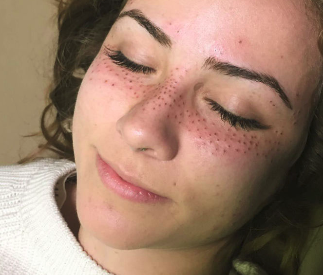 Eddig ciki volt, most mindenki tetováltatja a szeplőt