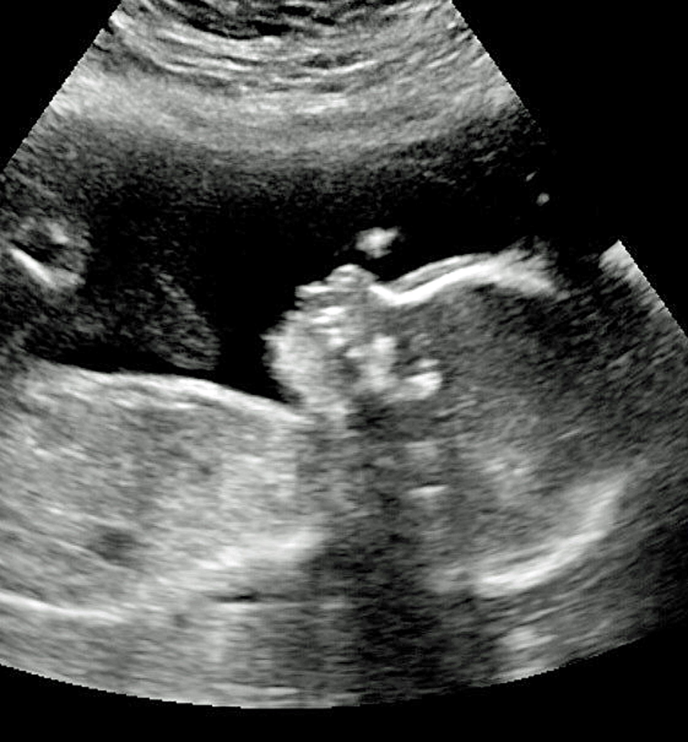 Gigantikus bozonttal született a kisfiú – az orvosoknak tátva maradt a szája 