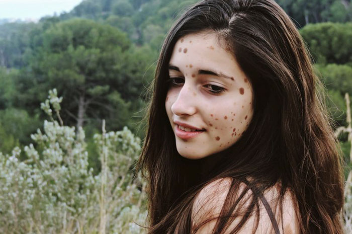 Csodaszép modell lett a bőrproblémái miatt zaklatott lányból