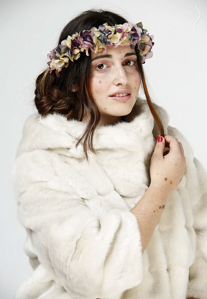 Csodaszép modell lett a bőrproblémái miatt zaklatott lányból