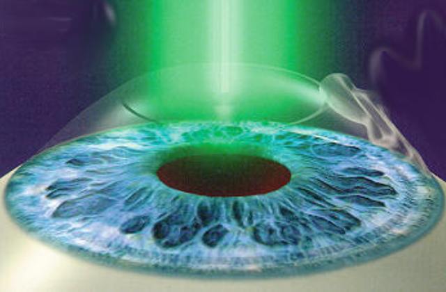 Szeretnéd letenni a szemüveget? – ezt kell tudnod a modern lézeres szemműtétekről Szeretnéd letenni a szemüveget? – ezt kell tudnod a modern lézeres szemműtétekről