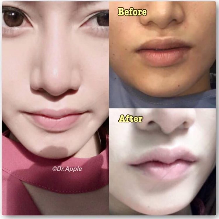 Bizarr formára műttetik ajkukat a thai nők