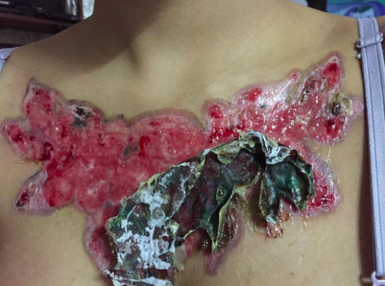 Brutális heg maradt az elrontott tetkó-eltávolítás után