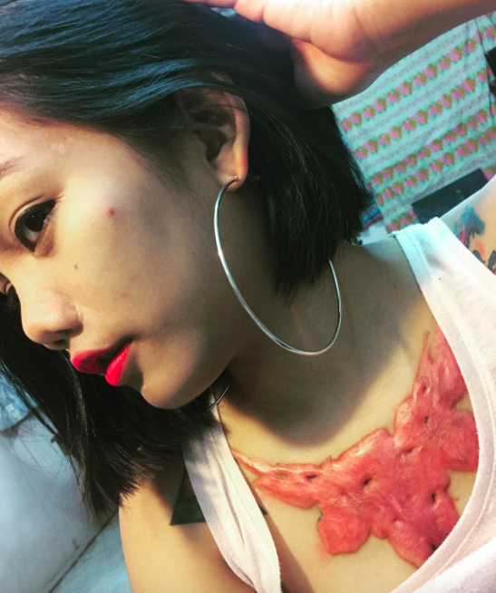 Brutális heg maradt az elrontott tetkó-eltávolítás után