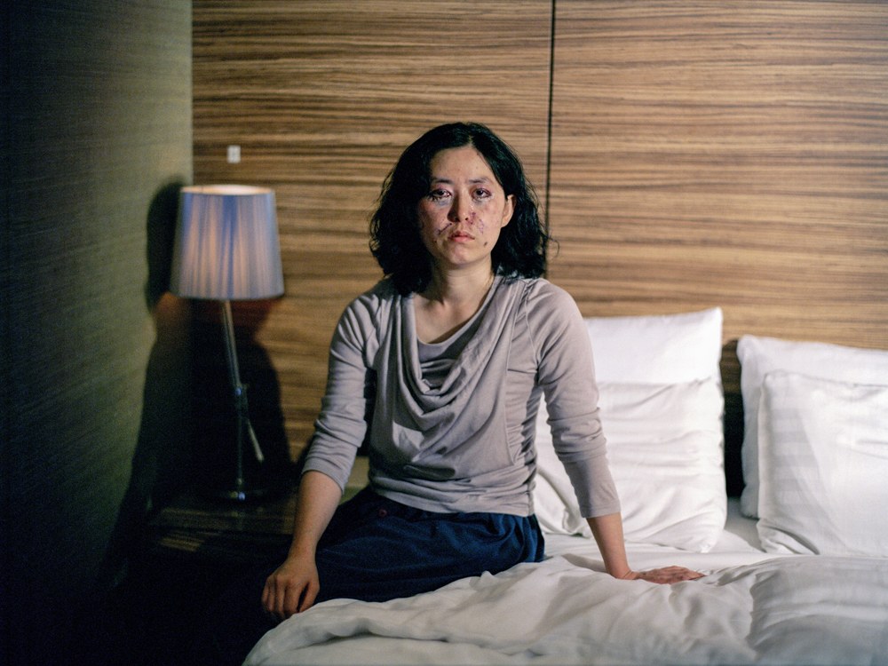 Élet, közvetlenül a plasztikai műtét után - meghökkentő fotók